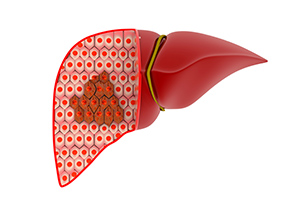 Benign Liver Tumor in Fort Myers, FL