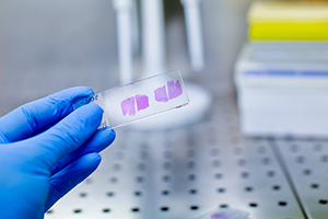 Liver Biopsy in Fort Myers, FL